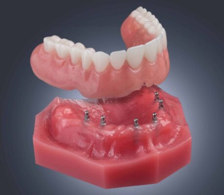 Denture Options in Buffalo, NY | Implant Dentures | Mini Implants