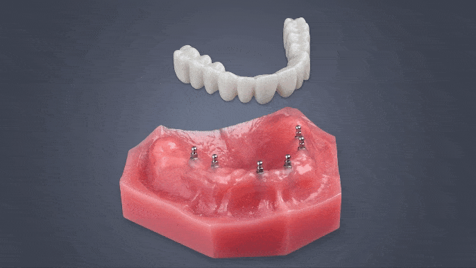 Floating Dentures in Buffalo, NY | Mini Implants | Implant Dentures