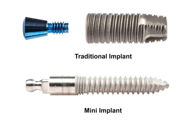 Mini Implant Procedure | Implant Dentist in Buffalo, NY | New Teeth