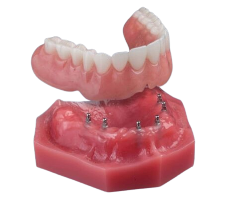 Snap In Dentures in Buffalo, NY | Book Your Free Consultation!